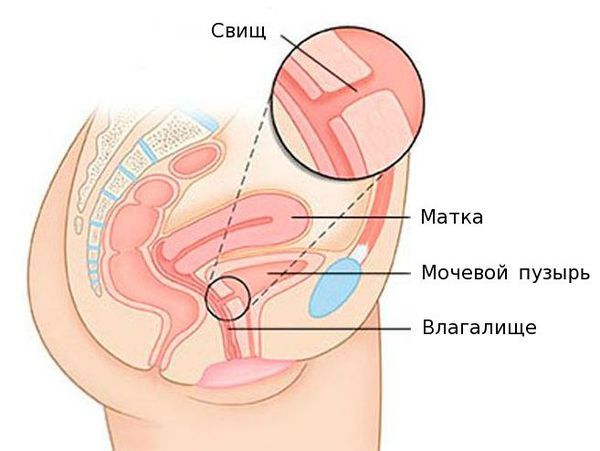 Фистулопластика при: • пузырно-влагалищных; • пузырно-маточных; • мачеточнико-влагалищных свищах; • мочеточниково- ректальных свищах.